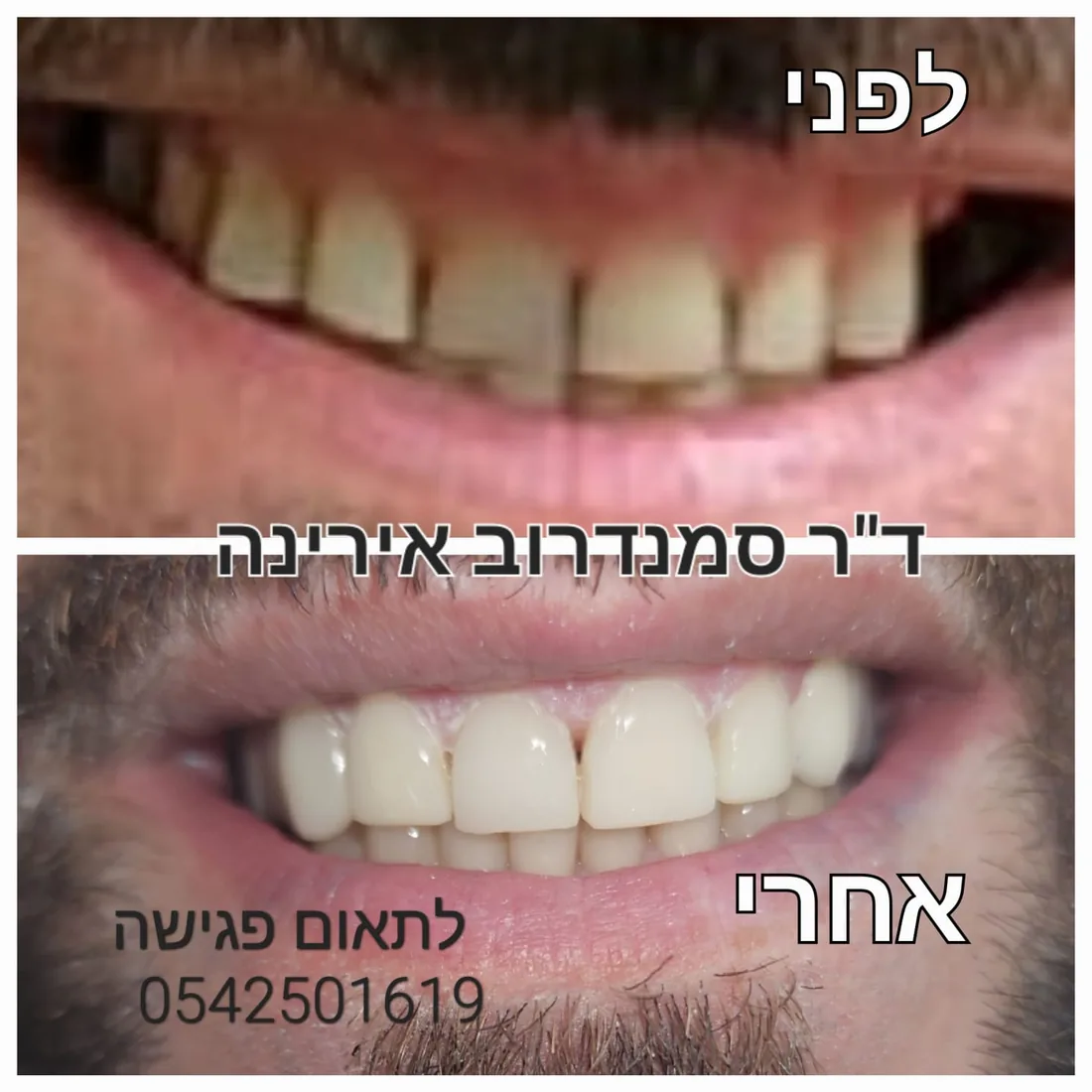 טיפול שיניים — לפני ואחרי
