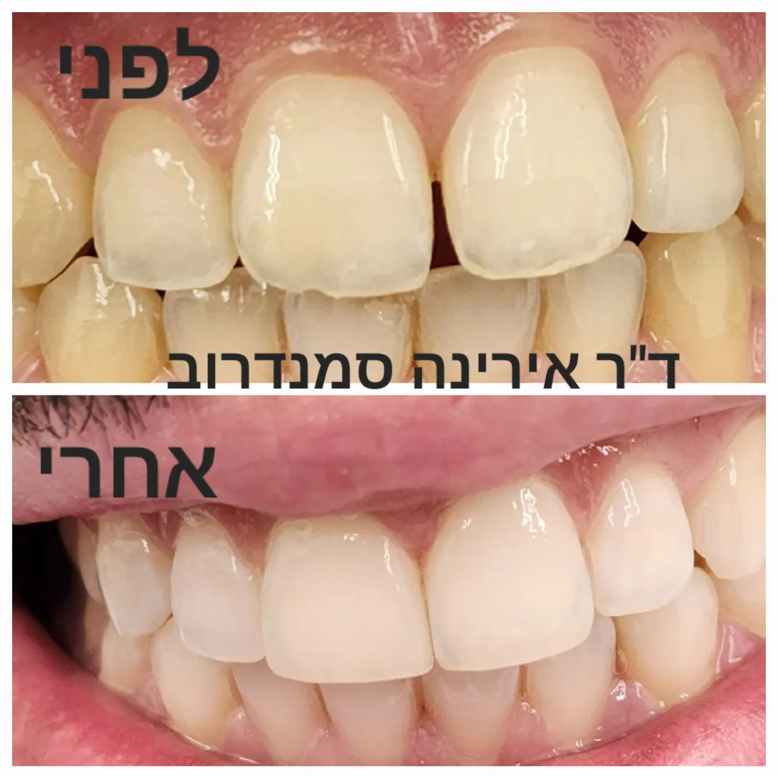 טיפול שיניים — לפני ואחרי