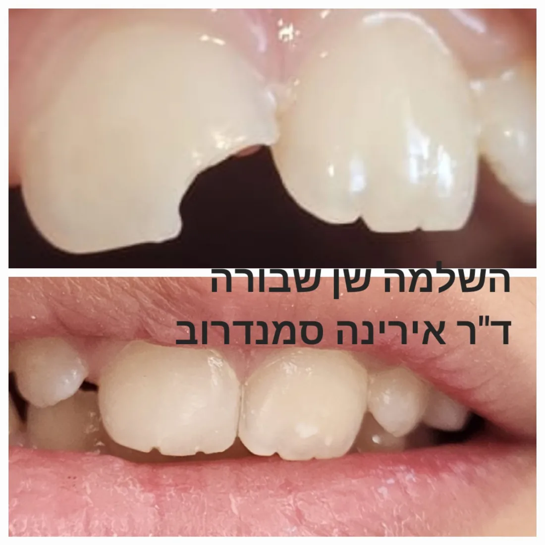 טיפול שיניים — לפני ואחרי
