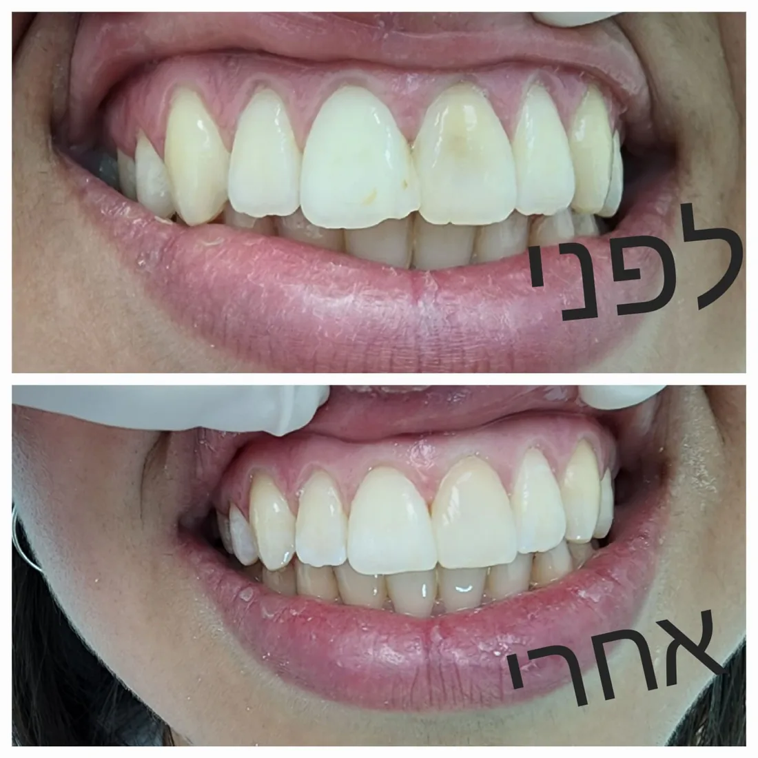 טיפול שיניים — לפני ואחרי