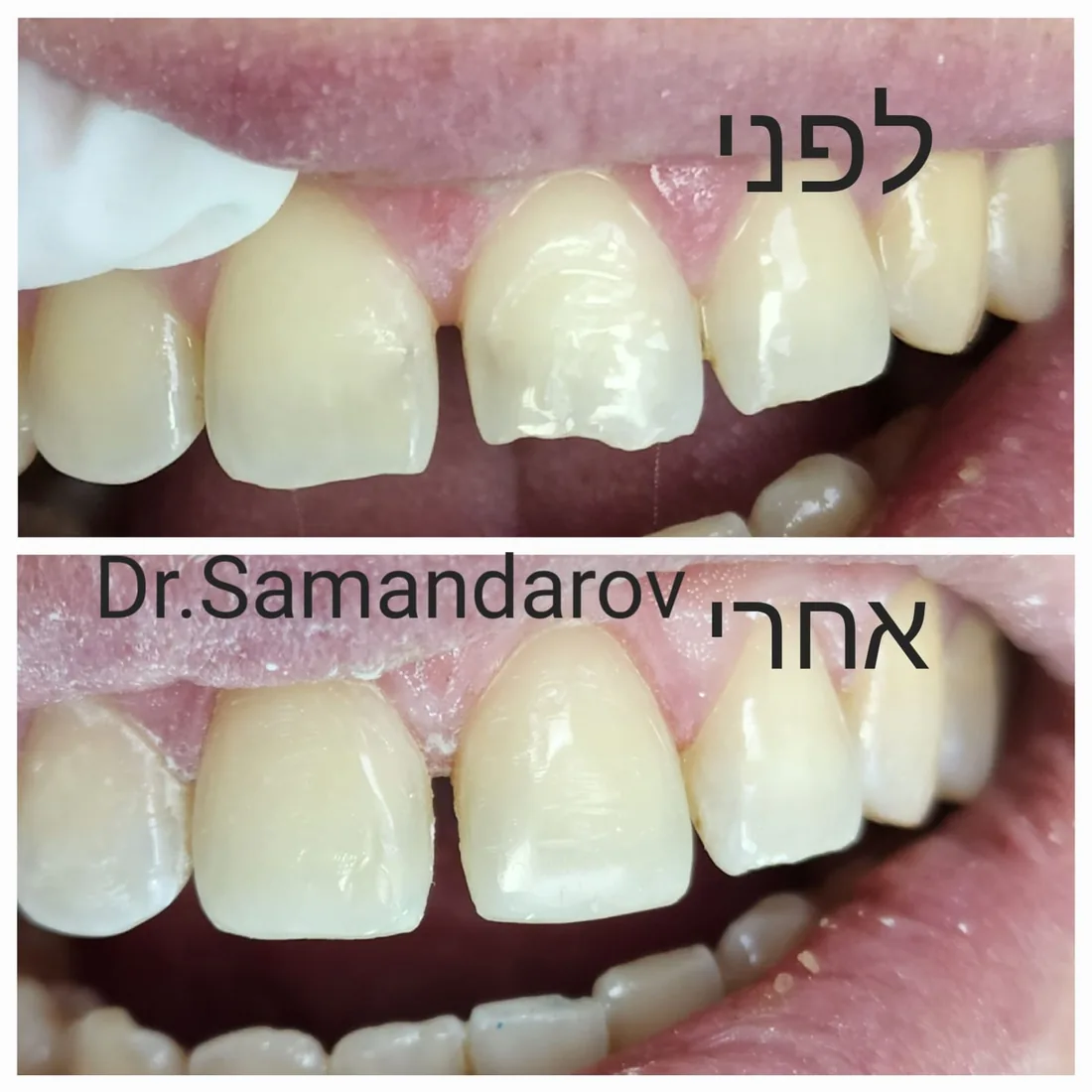 טיפול שיניים — לפני ואחרי