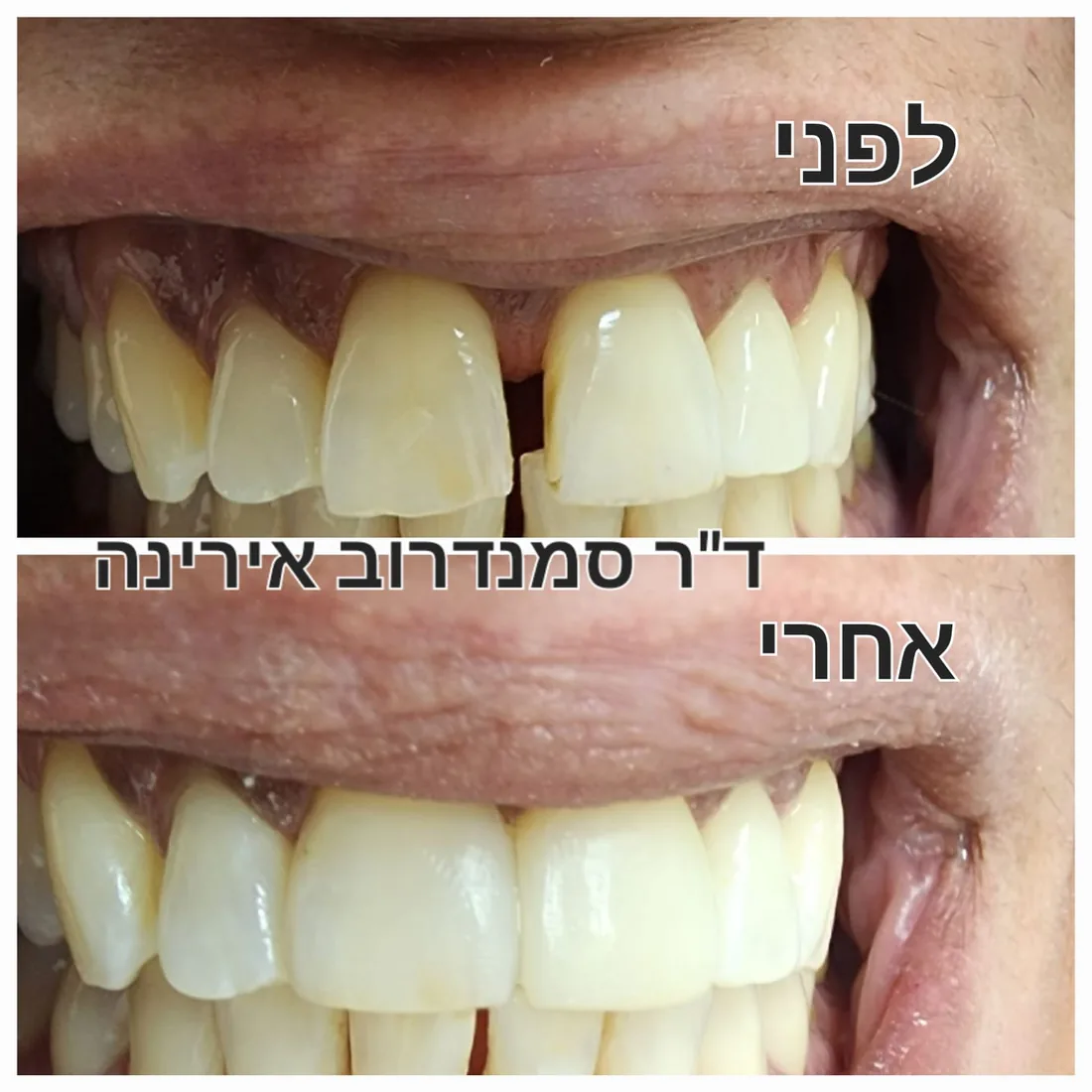טיפול שיניים — לפני ואחרי