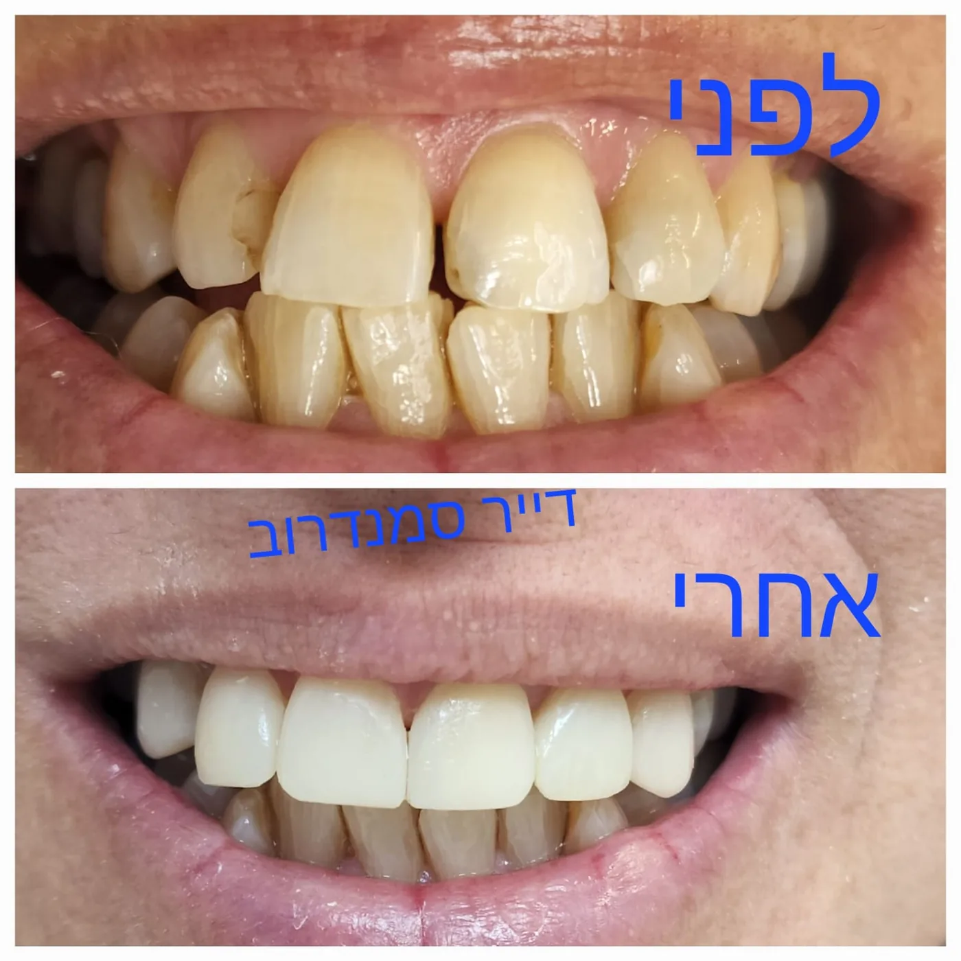 טיפול שיניים — לפני ואחרי