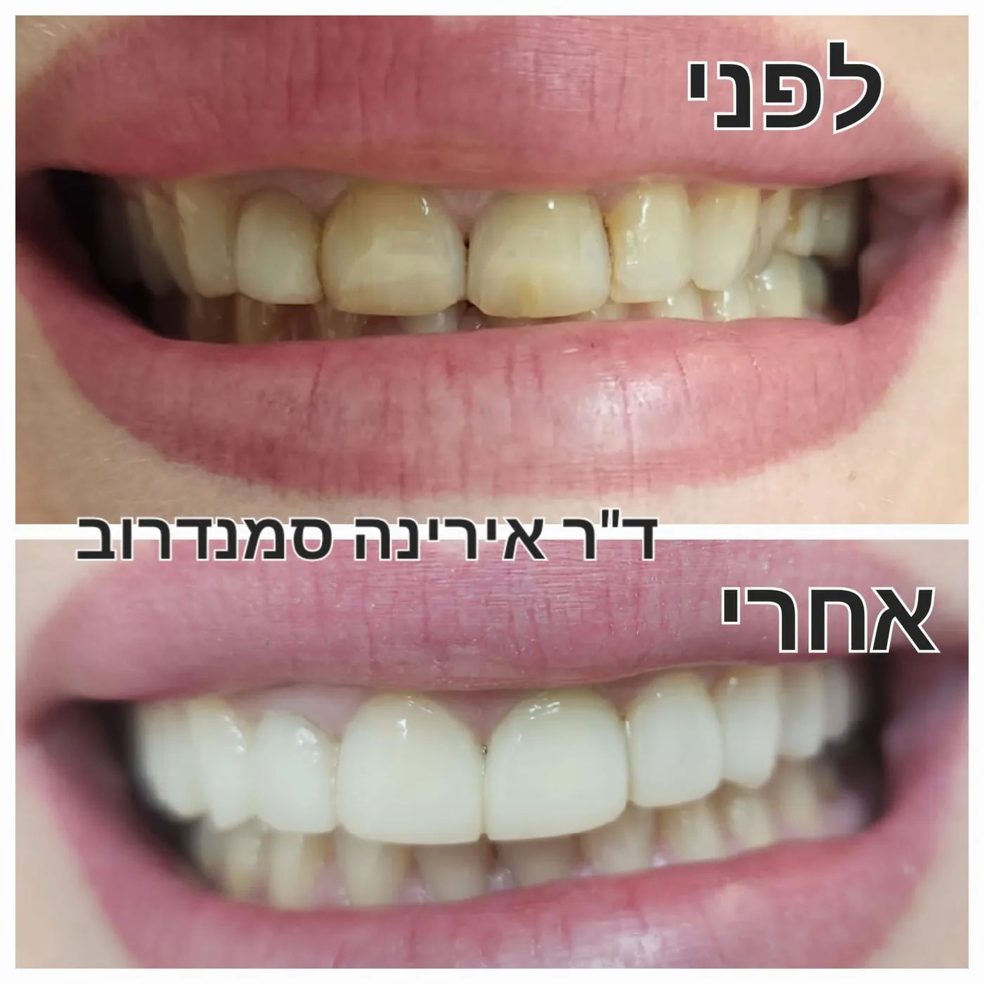 טיפול שיניים — לפני ואחרי