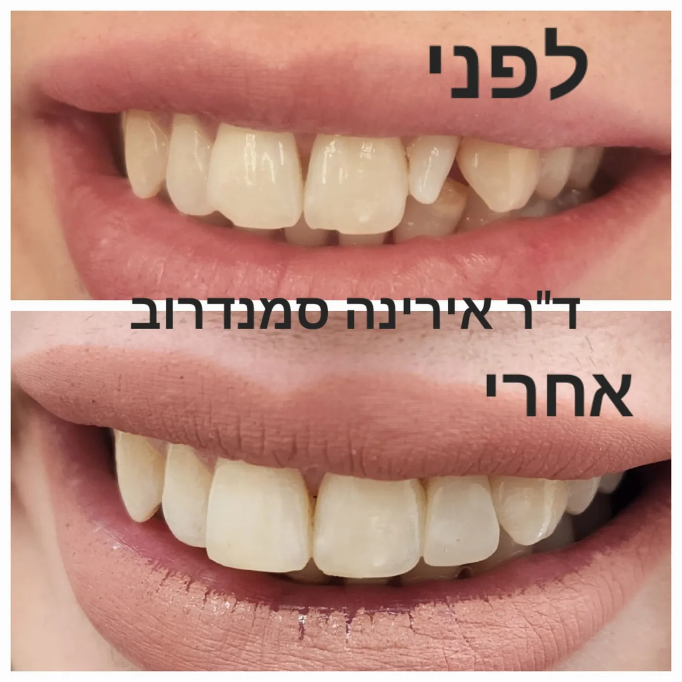 טיפול שיניים — לפני ואחרי