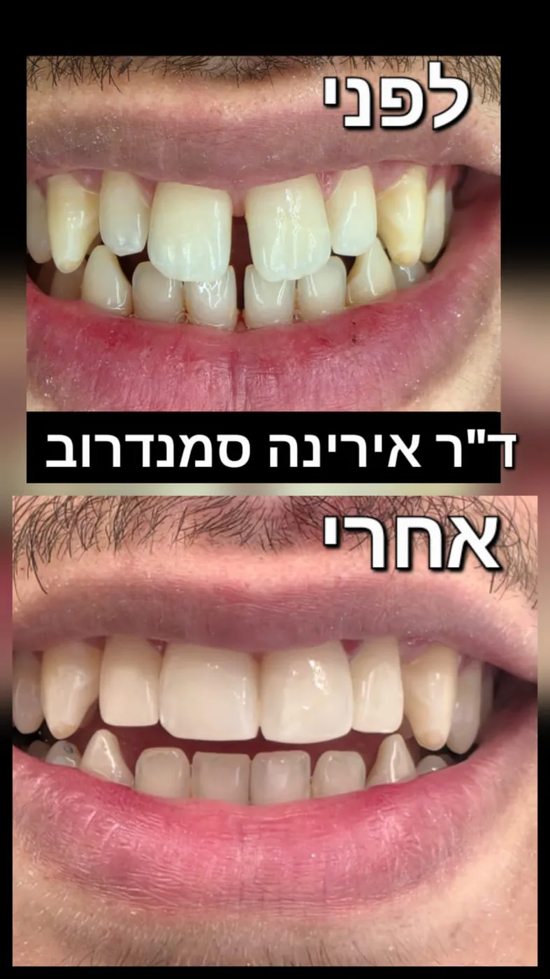 טיפול שיניים — לפני ואחרי