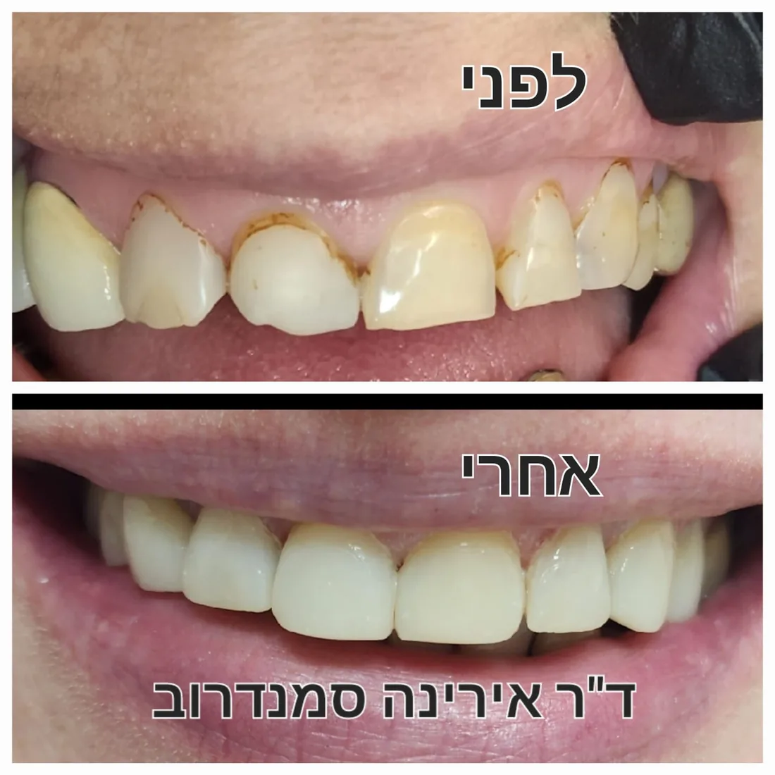 טיפול שיניים — לפני ואחרי