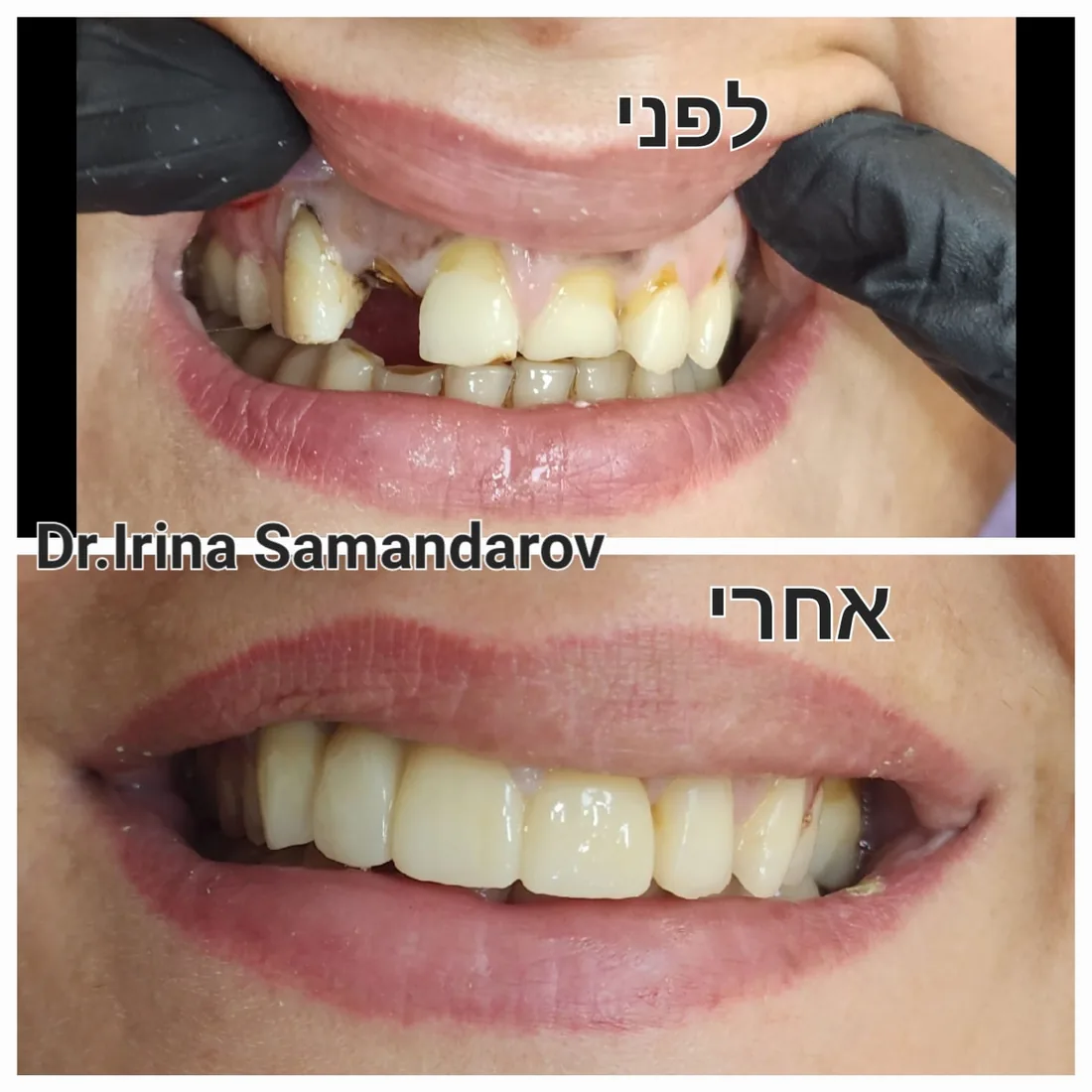 טיפול שיניים — לפני ואחרי