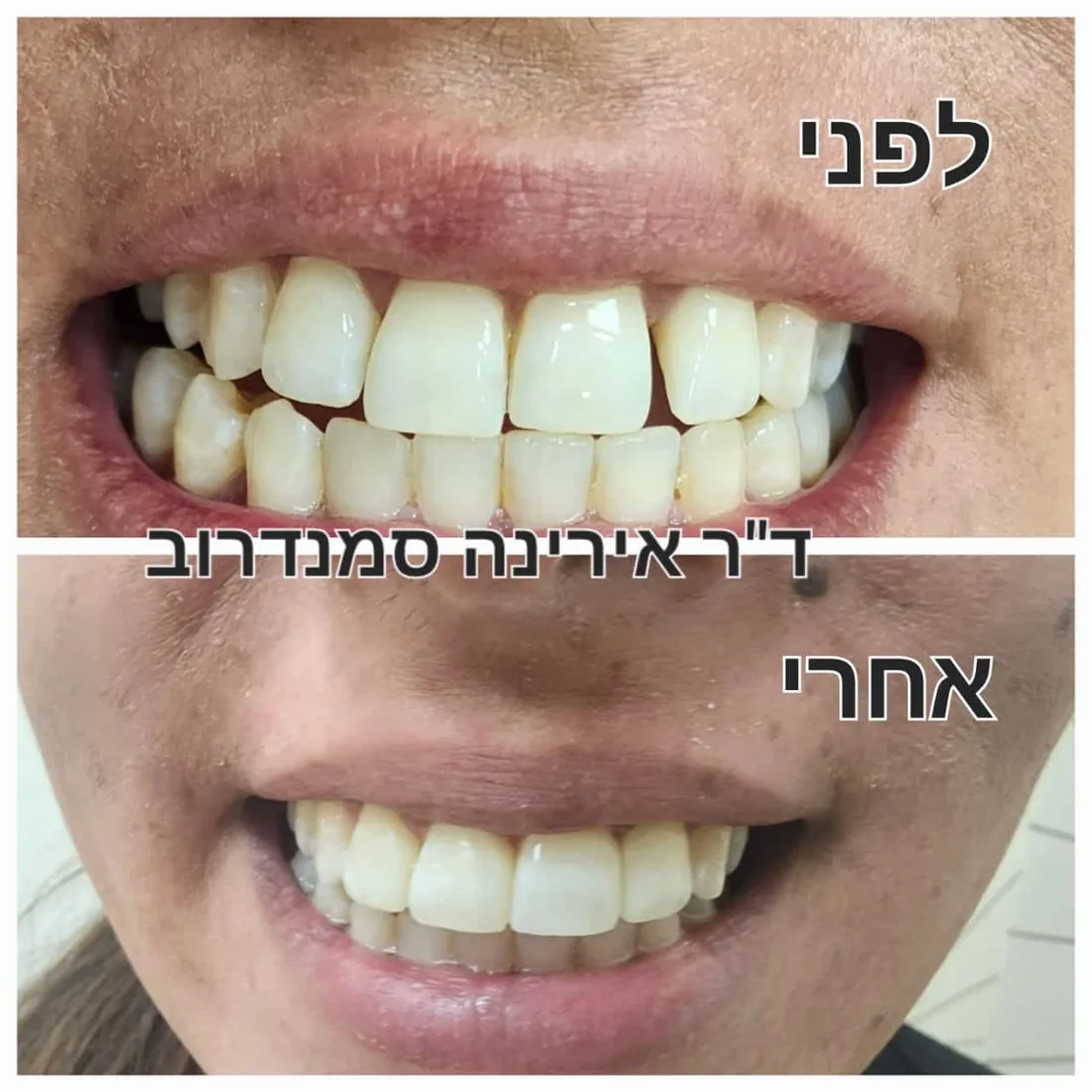 טיפול שיניים — לפני ואחרי